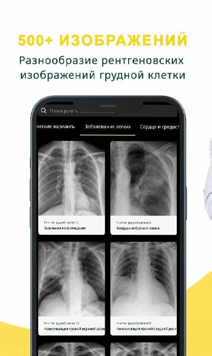 Chest X-ray screenshot 3