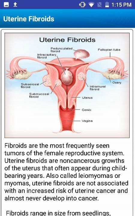 Uterine Fibroid Treatment Help screenshot 2
