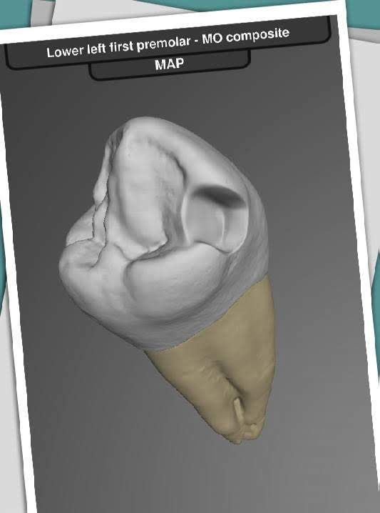 CavSim: Dental Cavity Trial screenshot 4
